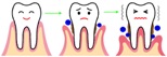 A mélyre jutó ínygyulladásról: a fogágybetegségről