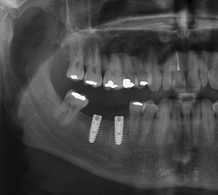 röntgen az implantátumokkal