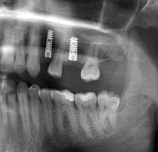 röntgen a 2 behelyezett implantátumról