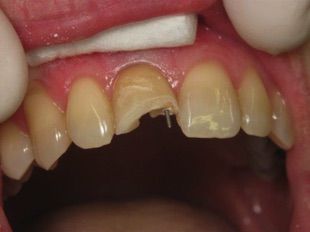 rögzített fogcsap a törött fogban